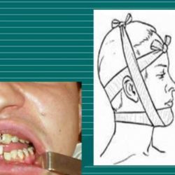 Челюсть не открывается до конца после перелома