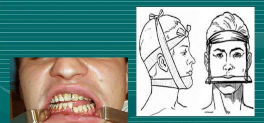Челюсть не открывается до конца после перелома