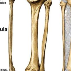 Поднадкостничный перелом большой берцовой кости у ребенка