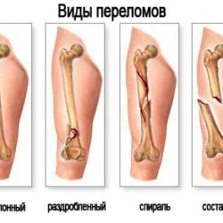 Фиксация ноги при переломе малой берцовой кости