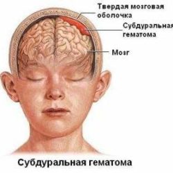 Гематома головы после ушиба симптомы и лечение