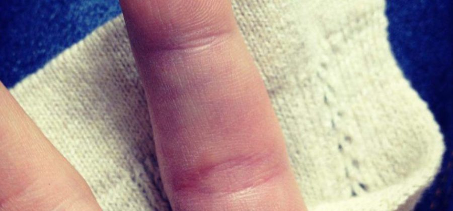 Как лечить ушиб пальца с отеком в домашних условиях?