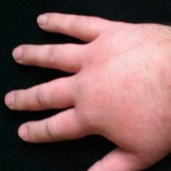 Как снять отек с рук и ног во время аллергии?